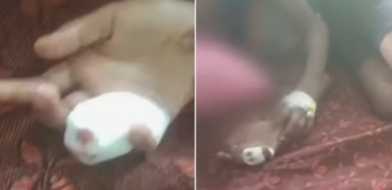 STRRAY DOG BITE
